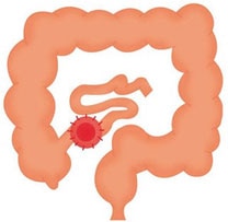 Ileostomía terminal Ileostomía terminal