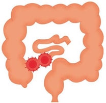 Ileostomía en asa Ileostomía en asa