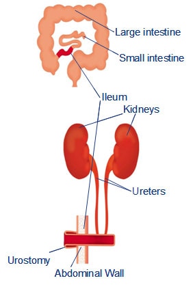 Urostomía