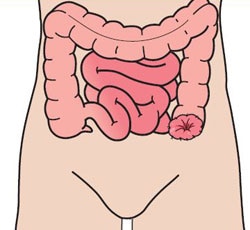 Colostomía