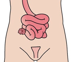 Ileostomía