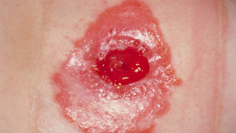 Irritación de la piel alrededor del ostoma