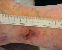 El área de la úlcera se redujo en un 95% después de cuatro semanas de tratamiento.