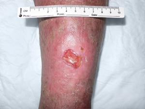 úlcera de la pierna 