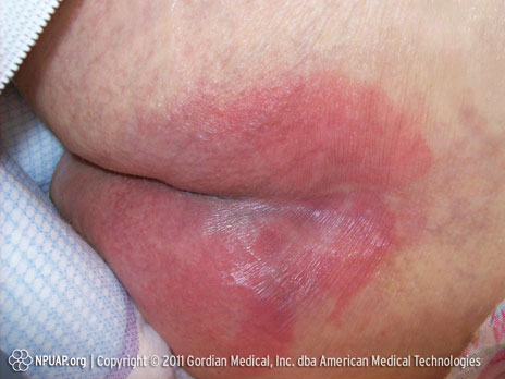 Úlcera por presión Categoría/Etapa I: Enrojecimiento no blanqueable de piel intacta