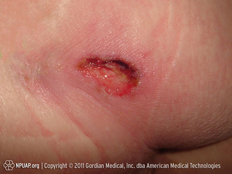 Úlcera por presión Categoría/Etapa III: Pérdida total del grosor de la piel (grasa visible)