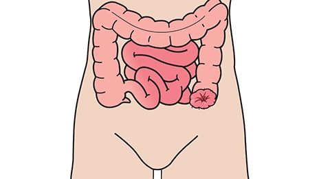 ¿Qué es una colostomía?