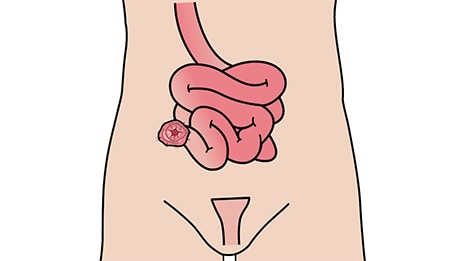 ¿Qué es una ileostomía?